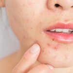 Dicas para eliminar a Acne