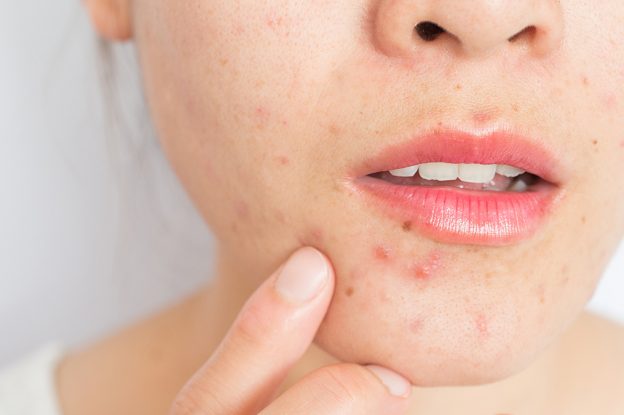 Dicas para eliminar a Acne