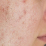 Anticoncepcionais: piores para acne e pele oleosa