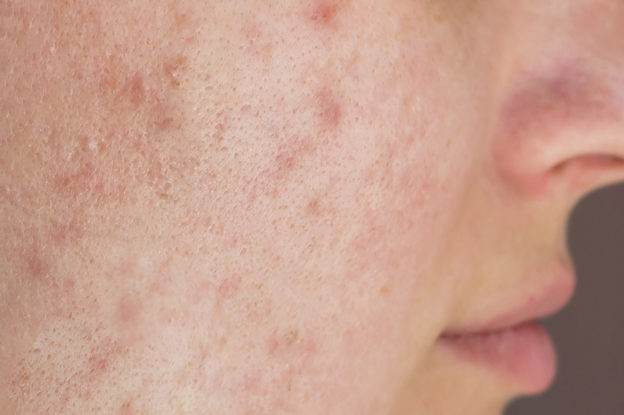 Anticoncepcionais: piores para acne e pele oleosa