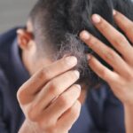 Minoxidil no cabelo: por que a queda continua?